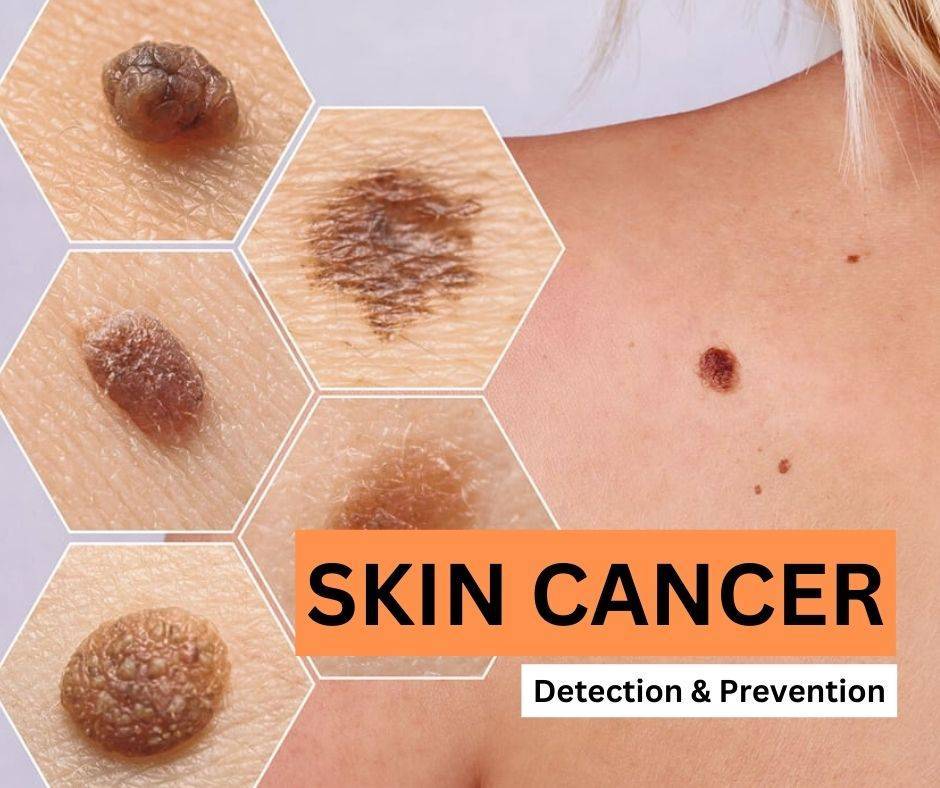 Skin Cancer is commonly found in people