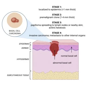 basal cell carcinoma stages