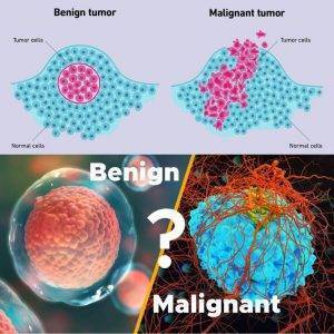 benign vs malignant tumor