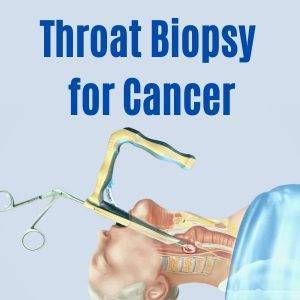Throat Biopsy