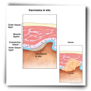 carcinoma condition in cancer