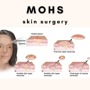 mohs skin surgery