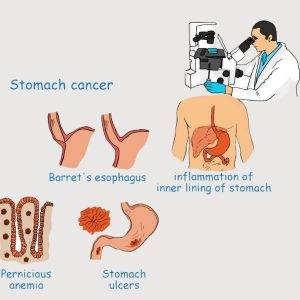 stomach cancer detection