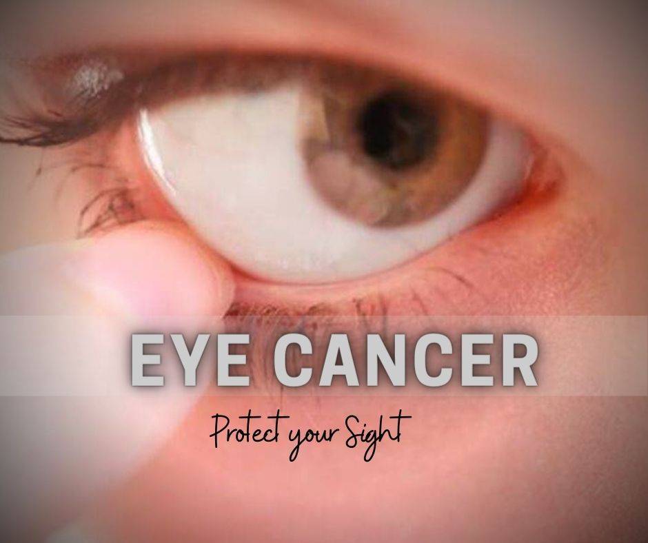 Eye Cancer Detection