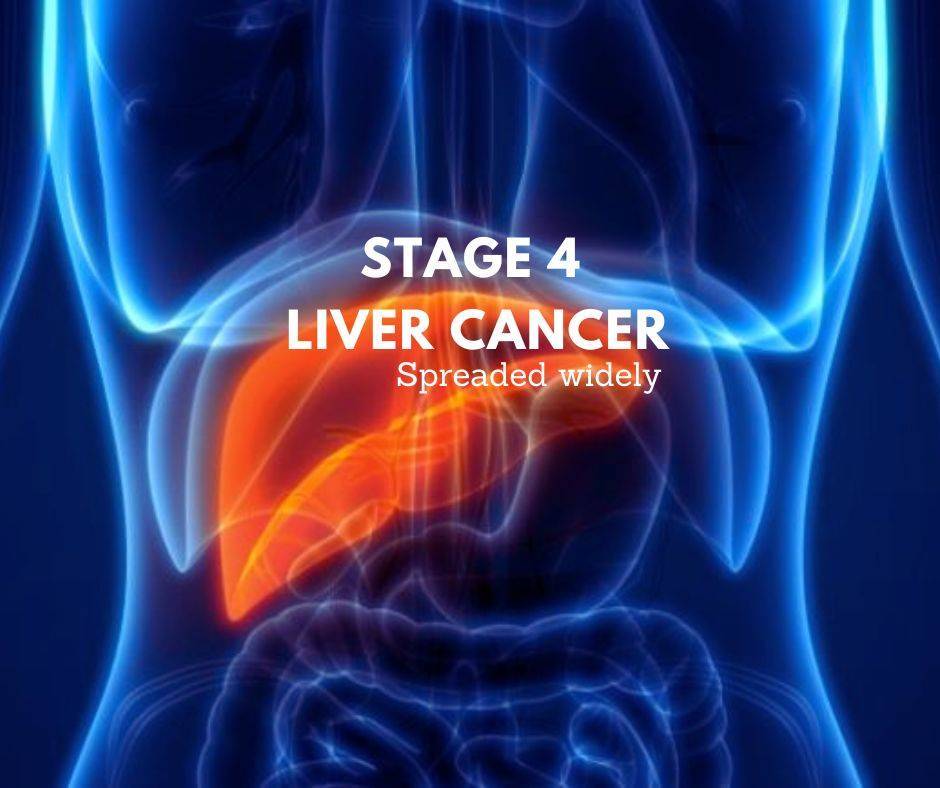 stage-4-liver-cancer