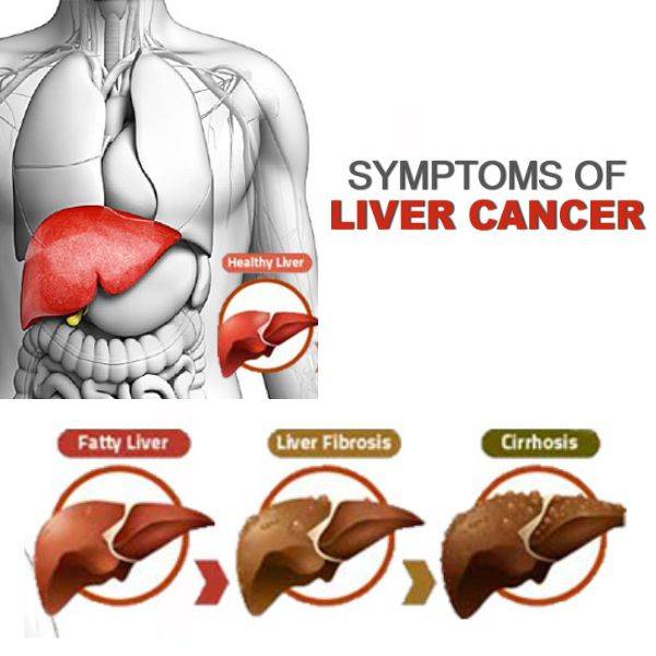 Stage 4 liver cancer