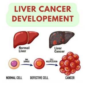 liver cancer development