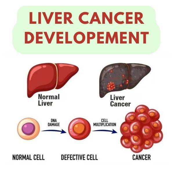 Stage 4 Liver Cancer 1417