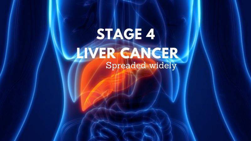 Stage 4 liver cancer