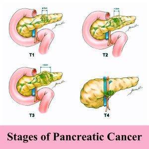 stages of pancreatic cancer