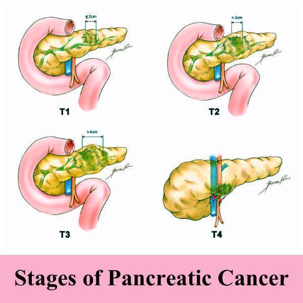 Pancreatic Cancer