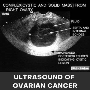 ultrasound of overian cancer