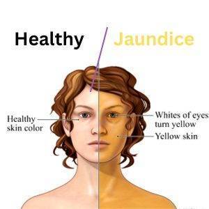 Jaundice-causes, prevention and required food