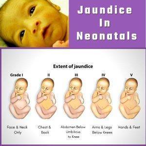Jaundice In Neonatals