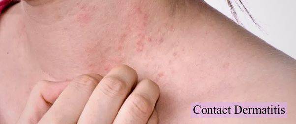 Contact dermatitis-skin allergy