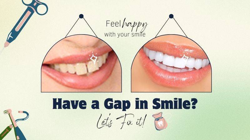 Have a Gap in Smile-Let's fix it!
