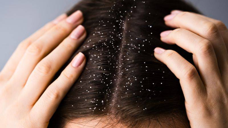 How to get rid of Dandruff