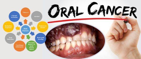 Oral cancer Risk Factors