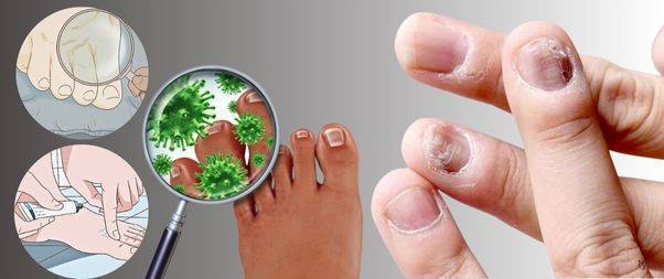 Precautions & Treatments for fungal infection