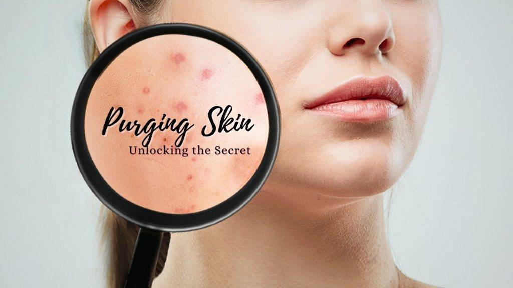 Purging skin-Good or Bad?