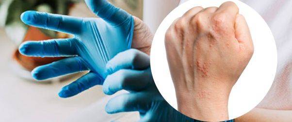 Skin Allergy From Gloves:Latex