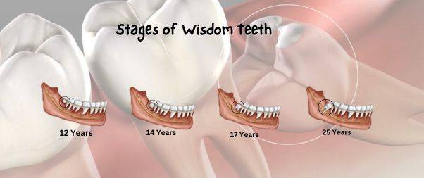 Stages of Wisdom teeth