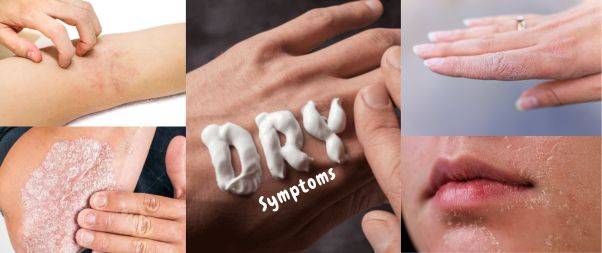 Symptoms of Dryness on skin