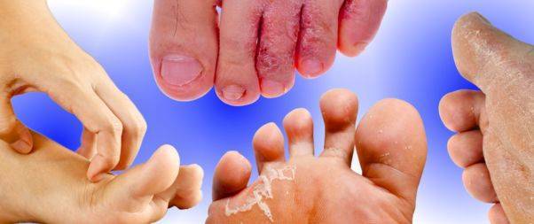 Types of fungal infection-Athlete's Foot