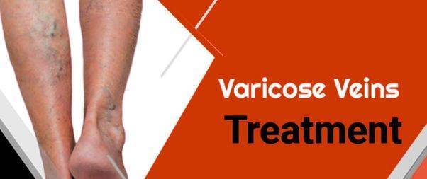 Varicose Vein Treatments