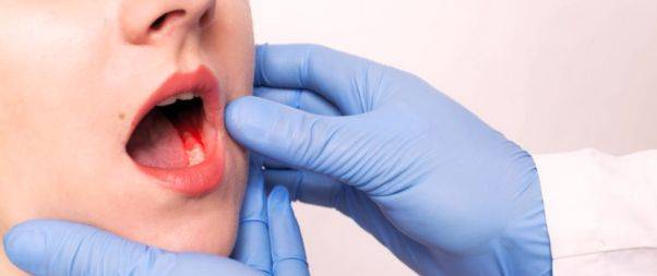 Warning signs of Buccal Mucosa Cancer