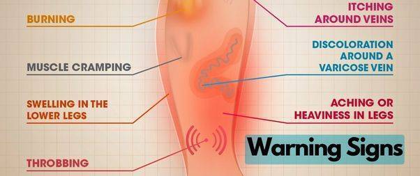Warning signs of varicose veins