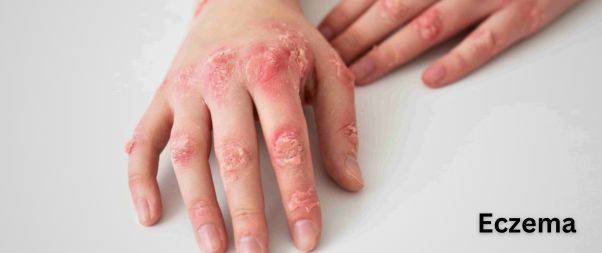 eczema-skin allergies