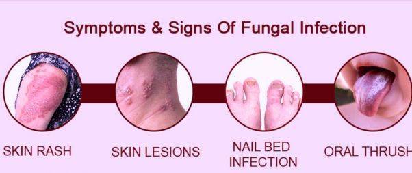 fungal infection-warning signs