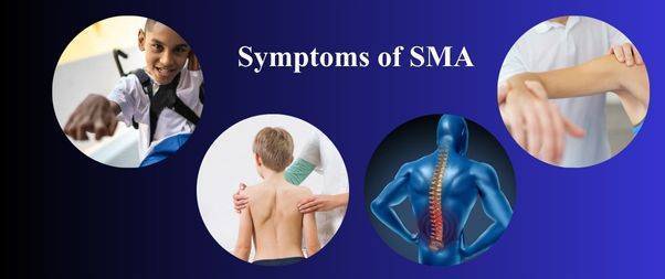 Symptoms of SMA