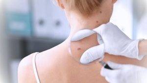 Caring For Your Wound After Skin Cancer Removal