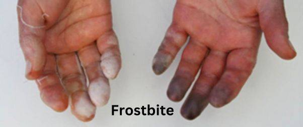 Frostbite of fingers during winters