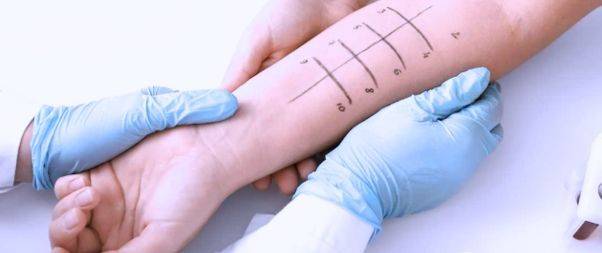 Skin Prick Test to Diagnose Allergy
