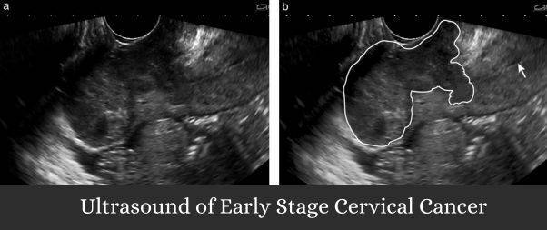 Ultrasound of Early Stage Cervical Cancer