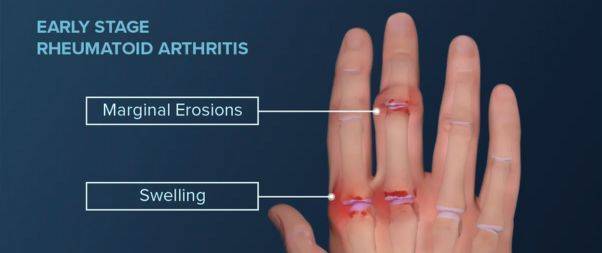 Warning Signs of Arthritis