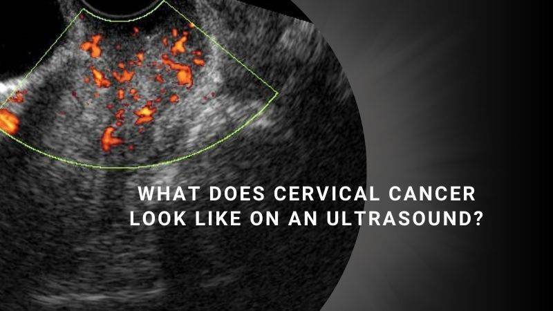 What Does Cervical Cancer Look Like on an Ultrasound?