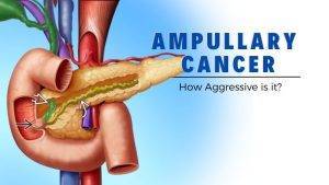 Ampullary Cancer-How aggressive is it?