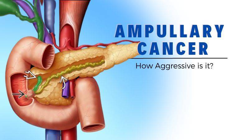 Ampullary Cancer-How aggressive is it?