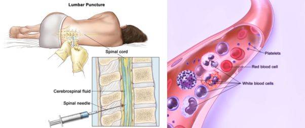 Lumbar Puncture(Spinal Tap)