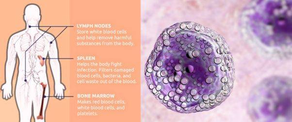 Diffuse large B-cell Lymphoma