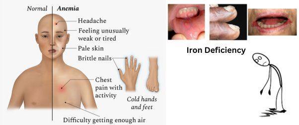 Effects of Anemia