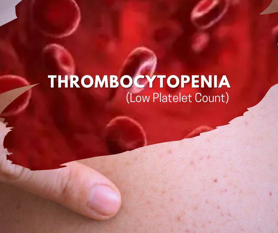 Thrombocytopenia