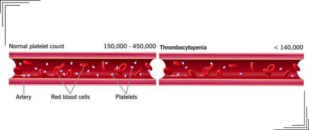 Low platelet count