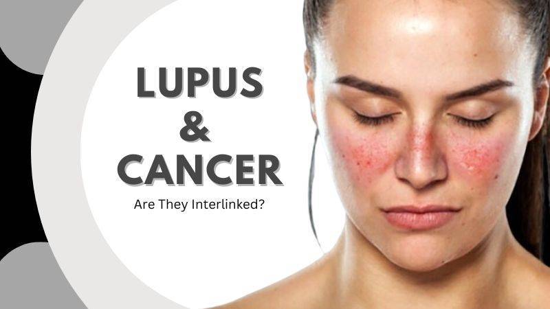 Lupus & Cancer-Are They Connected