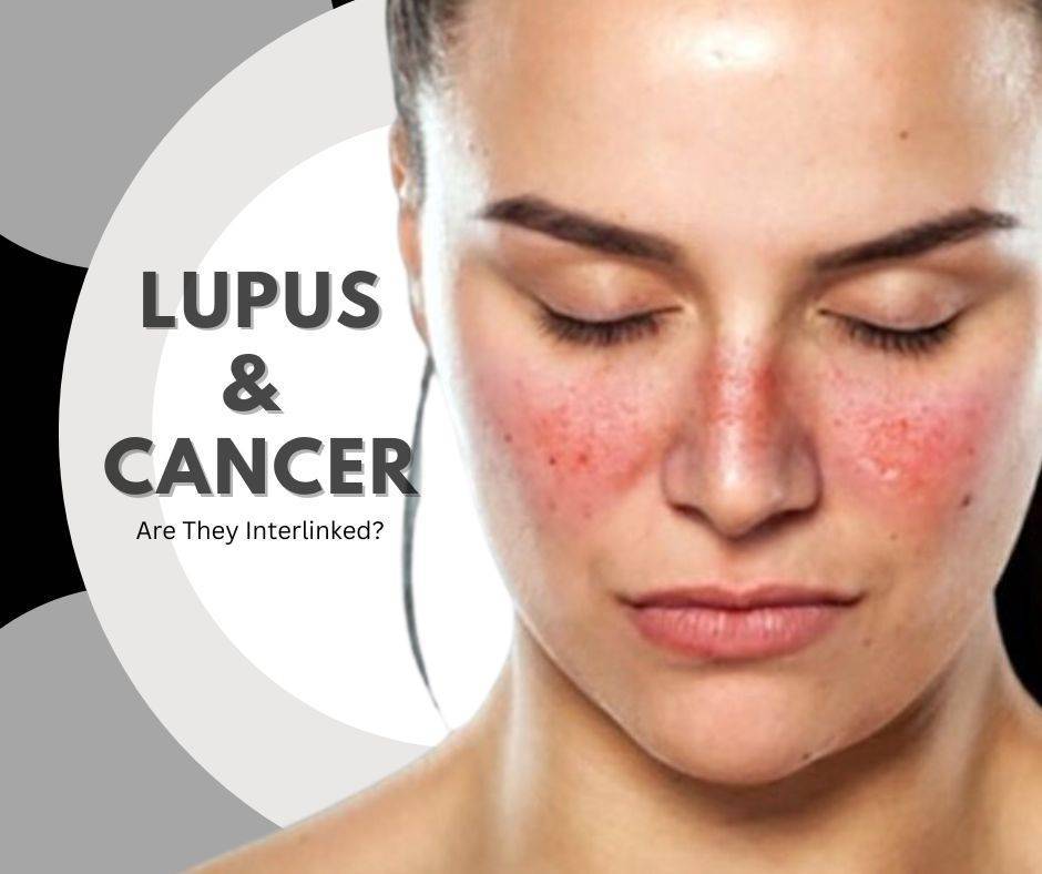 Understanding the Link Between Lupus and Cancer