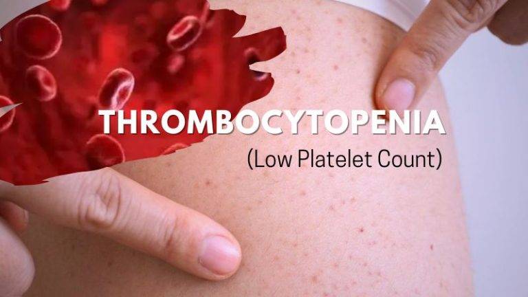 Thrombocytopenia